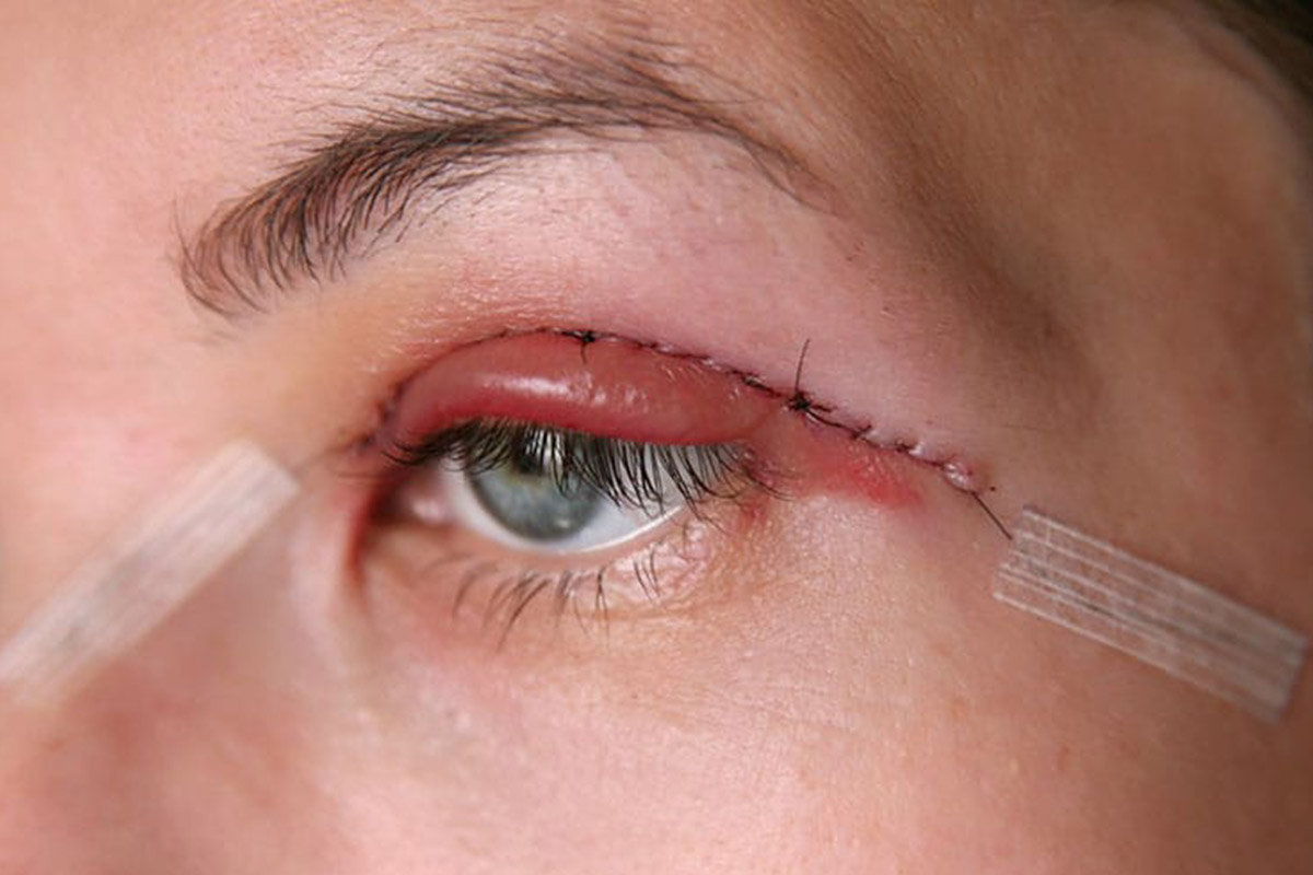 woman with stitches after blepharoplasty