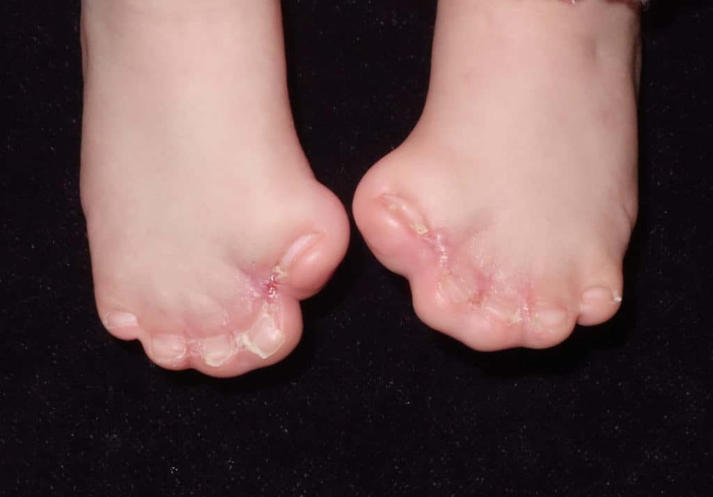 Apert syndrome