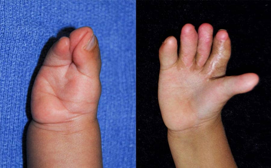 Apert syndrome