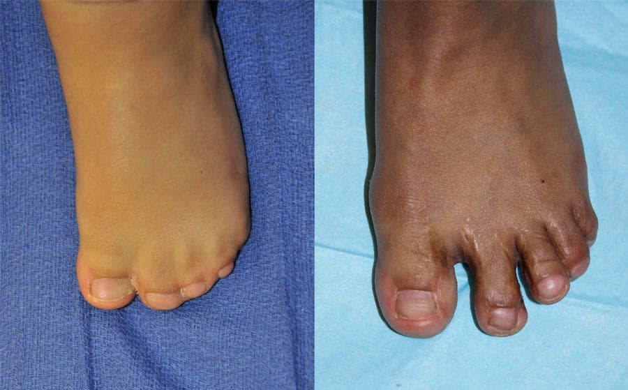 Apert syndrome