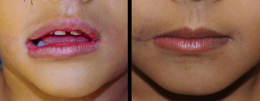 Before and after photo of child’s mouth following macrostomia repair