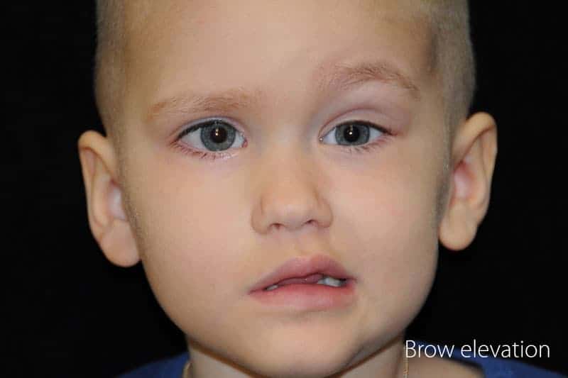 child with paralysis of the forehead