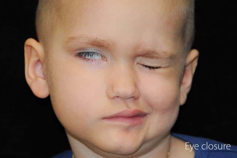 Child with facial paralysis trying to close eyes