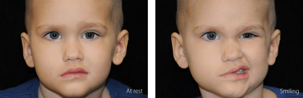 Child with facial paralysis at rest and trying to smile