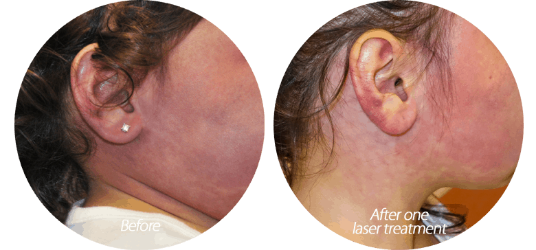 Before and after photo of child’s face after treatment with pulsed dye laser for capillary malformation, or port wine stain
