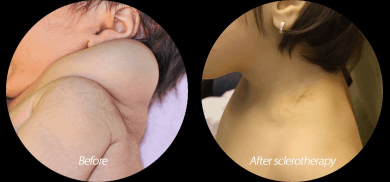 Before and after photo of child’s shoulder after sclerotherapy of lymphatic malformation