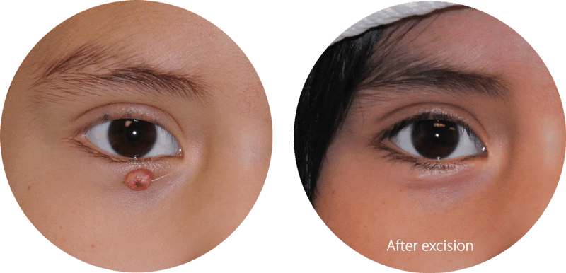 Pyogenic granuloma of a lower eyelid before and after excision