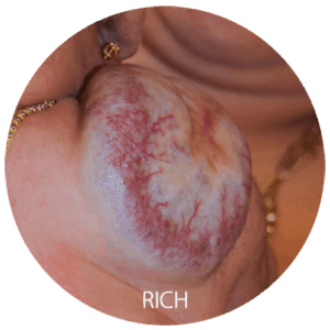 Rapidly-convoluting congenital hemangioma of a child’s shoulder