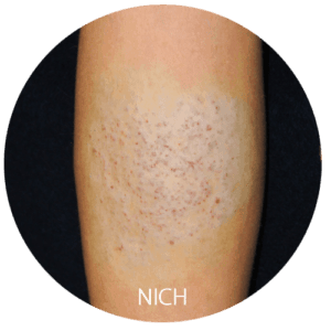 Non-involuting congenital hemangioma of arm