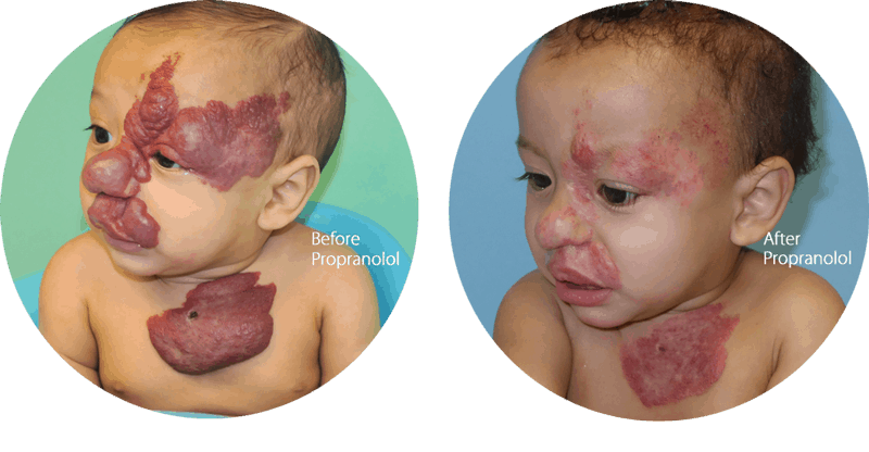 hemangiomas treatment results
