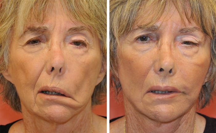 Before and after of a woman after static sling procedure for facial paralysis.