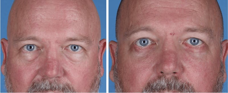 Eyelid Surgery (Blepharoplasty) Before & After Gallery - Patient 726999 - Image 1
