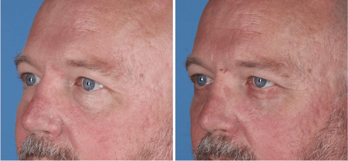 Eyelid Surgery (Blepharoplasty) Before & After Gallery - Patient 726999 - Image 3