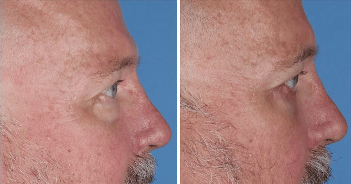 Eyelid Surgery (Blepharoplasty) Before & After Gallery - Patient 726999 - Image 2