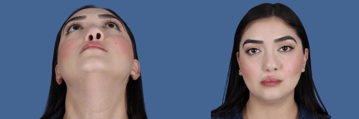 Cleft Lip Rhinoplasty Before & After Gallery - Patient 195298 - Image 1