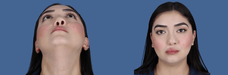 Cleft Lip Rhinoplasty Before & After Gallery - Patient 195298 - Image 1