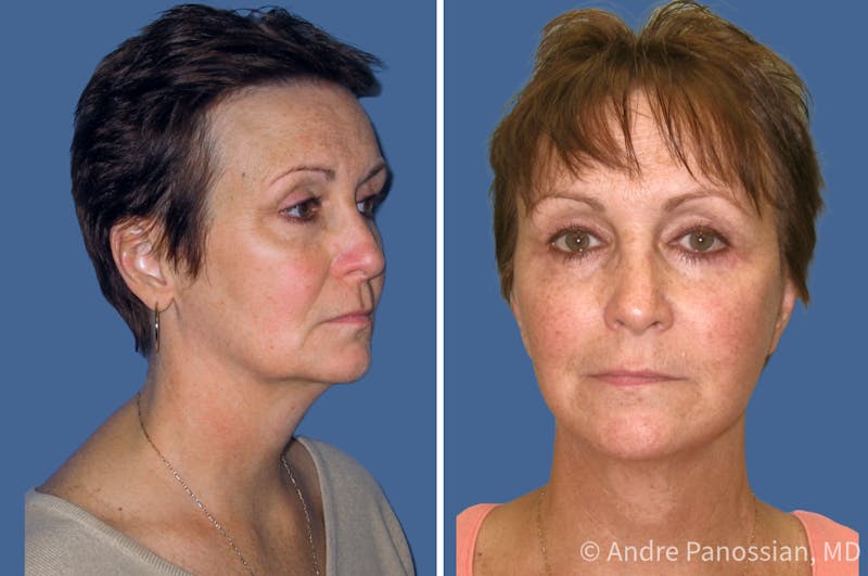 Facelift & Neck Lift Before & After Gallery - Patient 378726 - Image 1