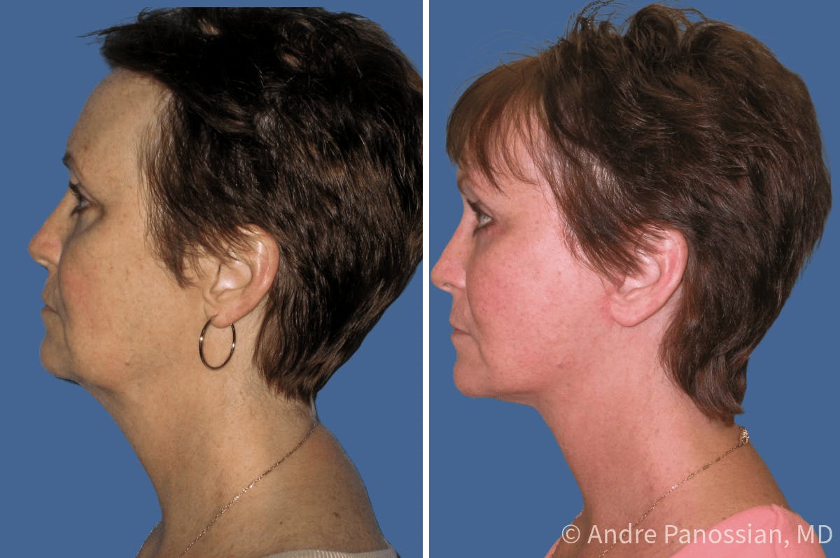 Facelift & Neck Lift Before & After Gallery - Patient 378726 - Image 2