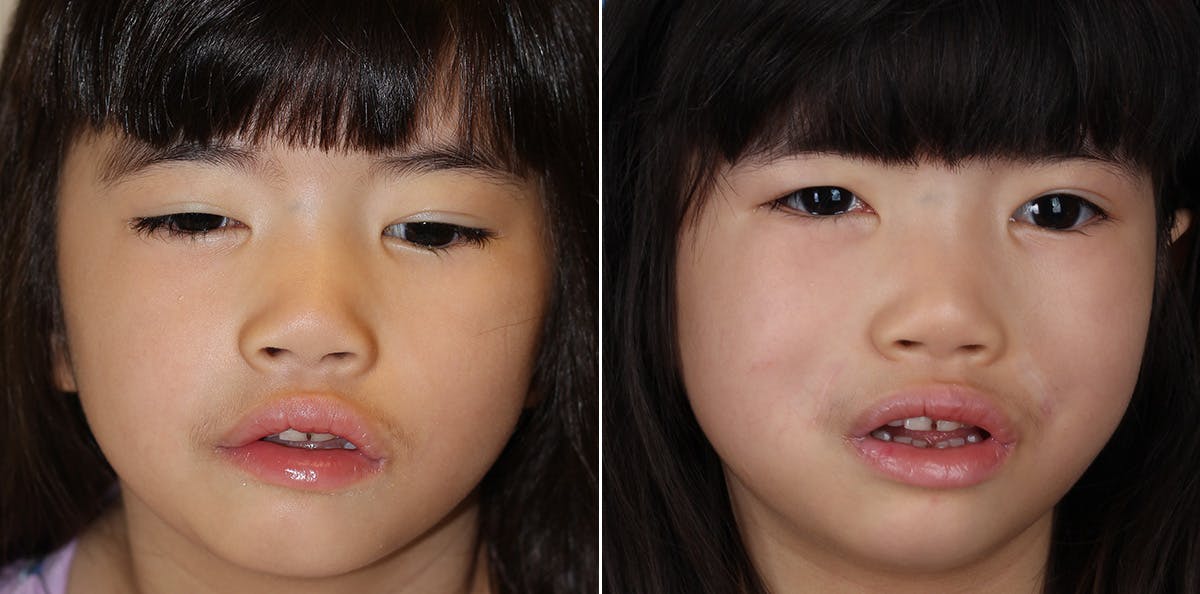 Smile Reanimation Before & After Gallery - Patient 864521 - Image 1