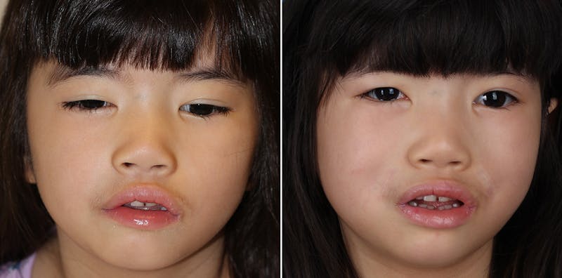 Smile Reanimation Before & After Gallery - Patient 864521 - Image 1