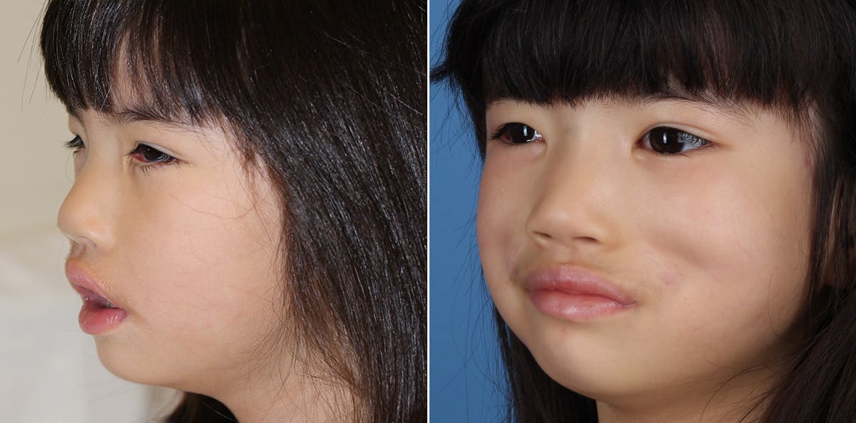 Smile Reanimation Before & After Gallery - Patient 864521 - Image 3