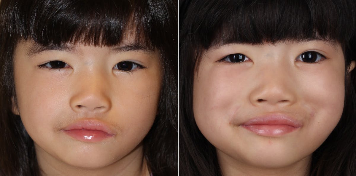 Smile Reanimation Before & After Gallery - Patient 864521 - Image 2