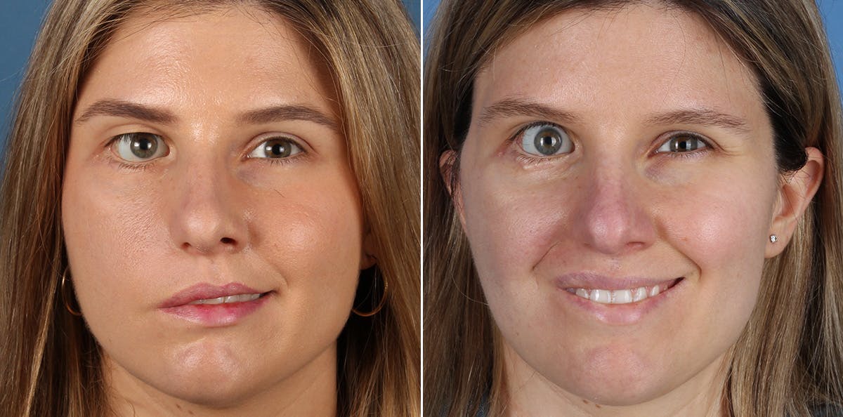 Smile Reanimation Before & After Gallery - Patient 227025 - Image 1