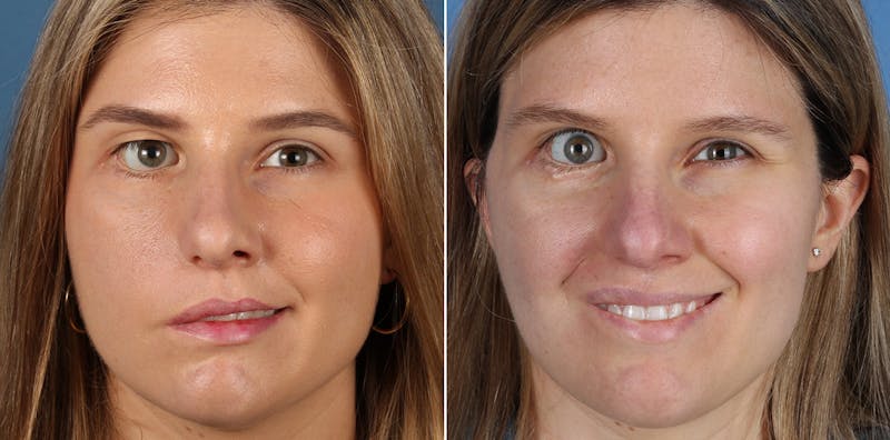 Smile Reanimation Before & After Gallery - Patient 227025 - Image 1