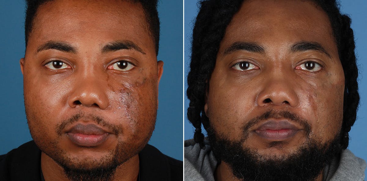 Smile Reanimation Before & After Gallery - Patient 340927 - Image 1