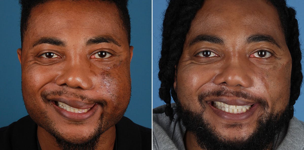 Smile Reanimation Before & After Gallery - Patient 340927 - Image 2