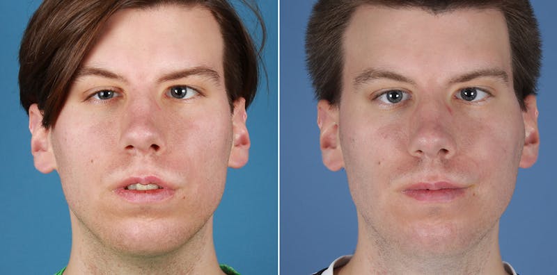 Smile Reanimation Before & After Gallery - Patient 416375 - Image 1