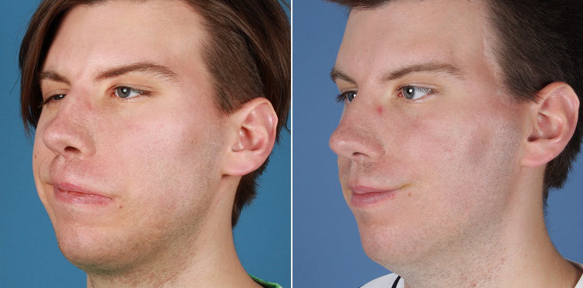 Smile Reanimation Before & After Gallery - Patient 416375 - Image 3