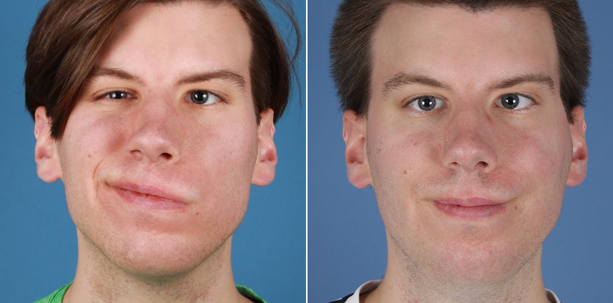 Smile Reanimation Before & After Gallery - Patient 416375 - Image 2