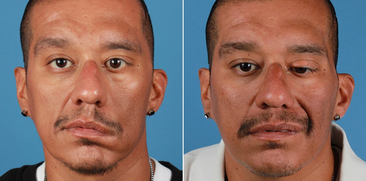 Smile Reanimation Before & After Gallery - Patient 407842 - Image 1