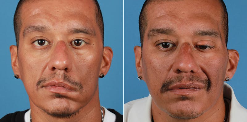 Smile Reanimation Before & After Gallery - Patient 407842 - Image 1
