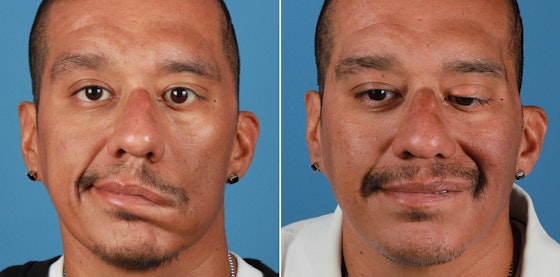 Facial reanimation — smile restoration before and after — actual patient of Andre Panossian, MD
