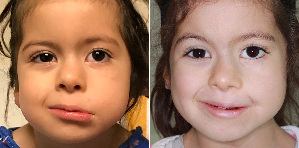Smile Reanimation Before & After Gallery - Patient 993410 - Image 1
