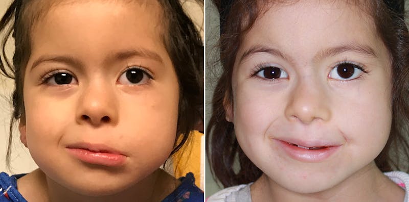 Smile Reanimation Before & After Gallery - Patient 993410 - Image 1