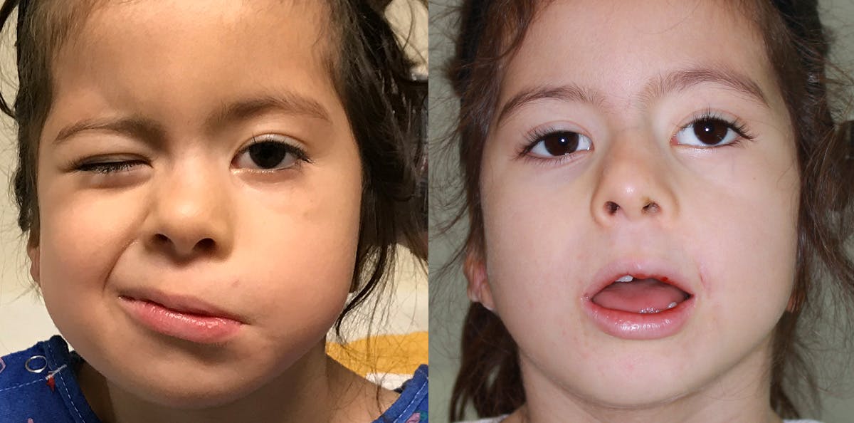 Smile Reanimation Before & After Gallery - Patient 993410 - Image 2