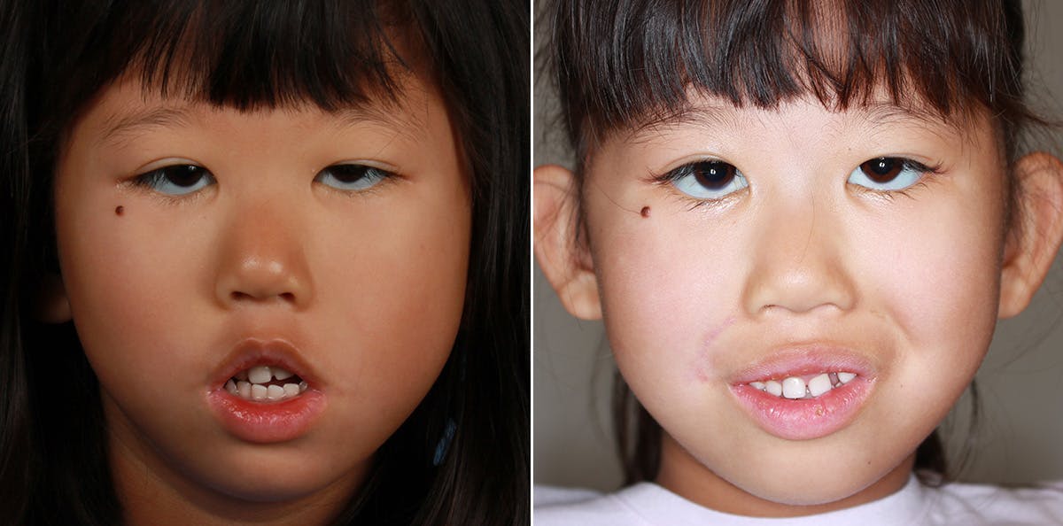 Smile Reanimation Before & After Gallery - Patient 166728 - Image 1