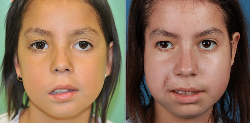 Smile Reanimation Before & After Gallery - Patient 265005 - Image 1