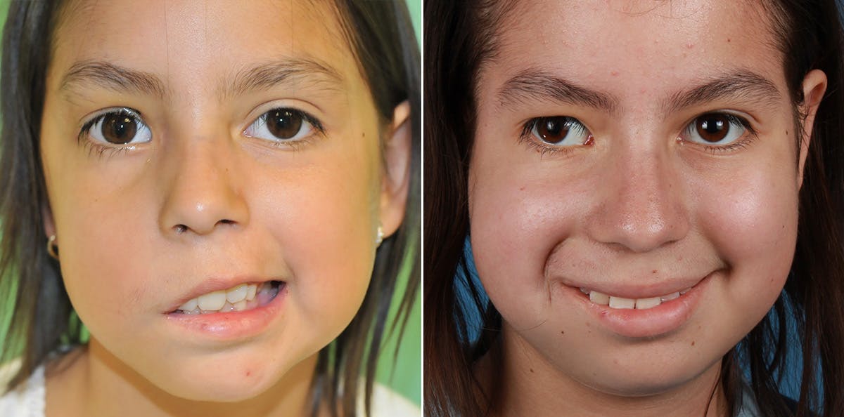 Smile Reanimation Before & After Gallery - Patient 265005 - Image 2
