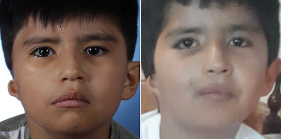 Facial reanimation — smile restoration before and after — actual patient of Andre Panossian, MD