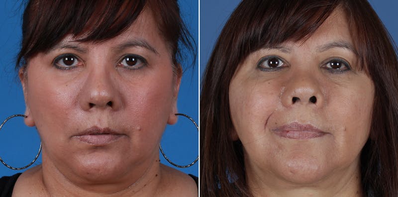Smile Reanimation Before & After Gallery - Patient 844447 - Image 1