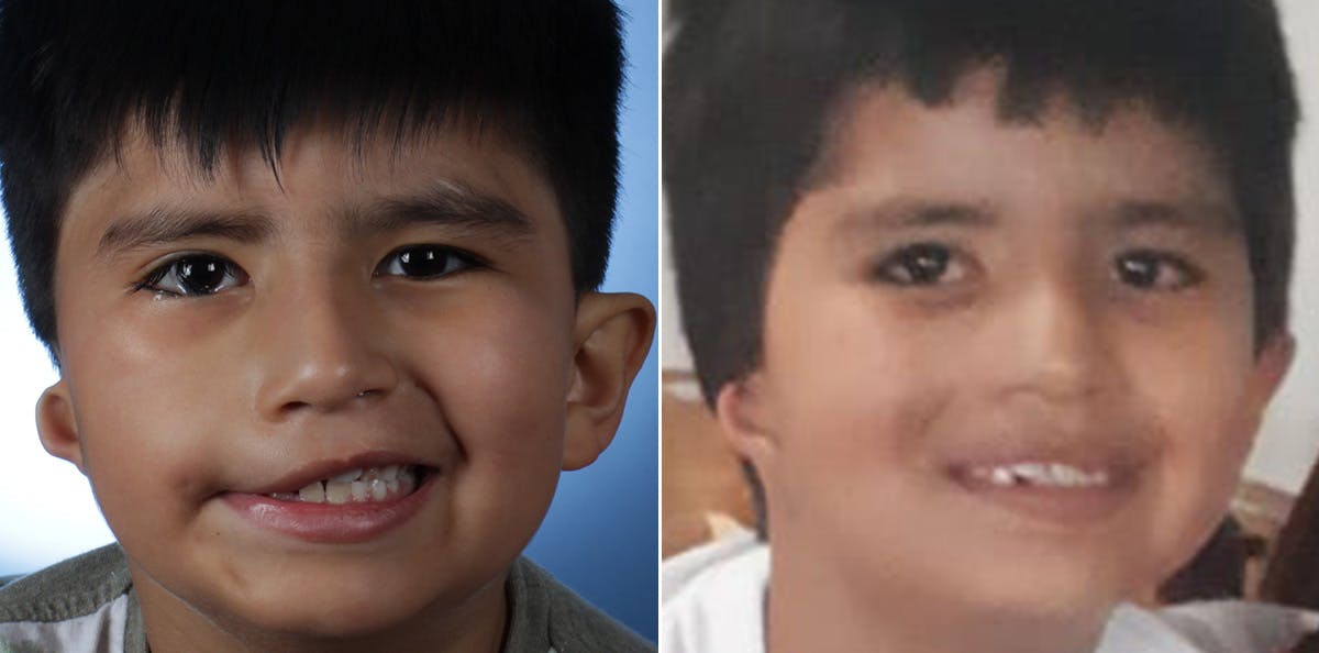 Smile Reanimation Before & After Gallery - Patient 165832 - Image 2