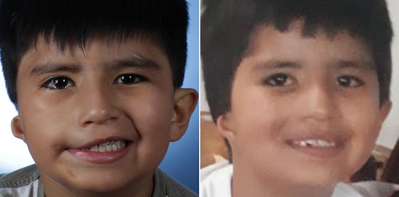 Facial reanimation — smile restoration before and after — actual patient of Andre Panossian, MD