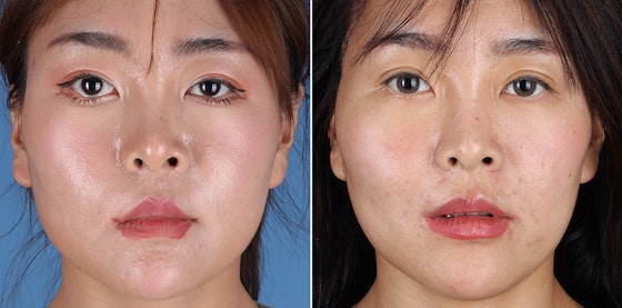 Facial reanimation — smile restoration before and after — actual patient of Andre Panossian, MD