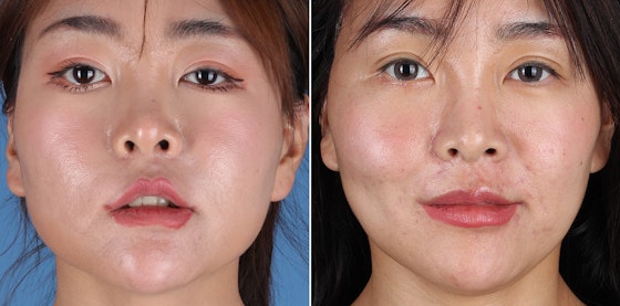 Facial reanimation — smile restoration before and after — actual patient of Andre Panossian, MD