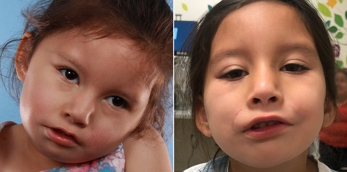 Smile Reanimation Before & After Gallery - Patient 153981 - Image 1