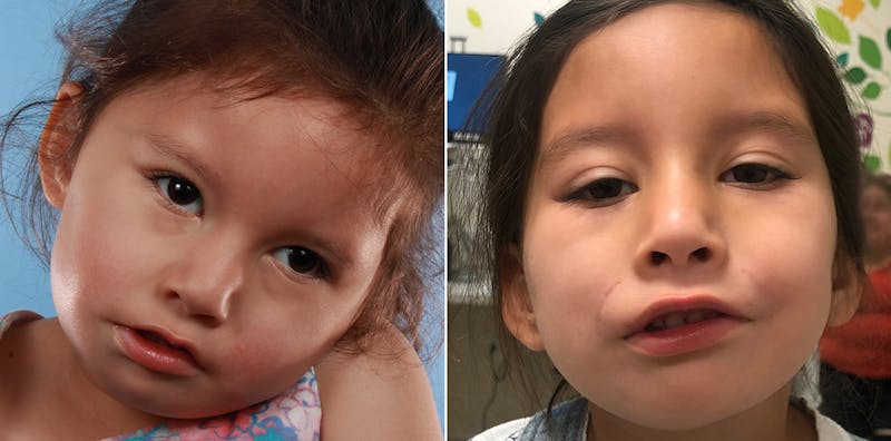 Smile Reanimation Before & After Gallery - Patient 153981 - Image 1